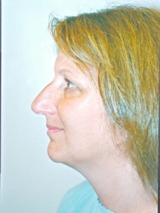 Face Lift and Neck Lift Patient 21688 Before Photo # 3