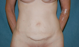 Mini Tummy Tuck Patient 65699 Before Photo # 1