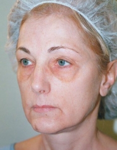 Face Lift and Neck Lift Patient 40143 Before Photo # 3