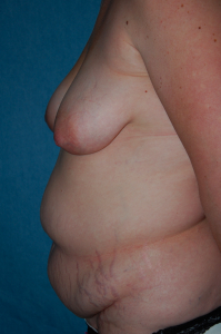 Tummy Tuck Patient 36881 Before Photo # 5