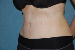 Tummy Tuck Patient 92915 After Photo # 4