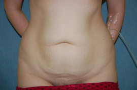 Mini Tummy Tuck Patient 58662 Before Photo # 1