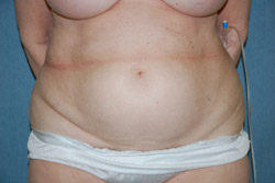Tummy Tuck Patient 92915 Before Photo # 1