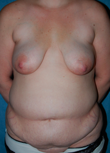 Tummy Tuck Patient 36881 Before Photo # 1