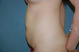 Mini Tummy Tuck Patient 58662 Before Photo # 5