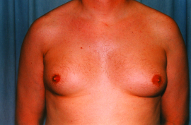 Gynecomastia Patient 93696 Before Photo # 1