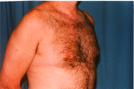 Gynecomastia Patient 45827 After Photo # 2