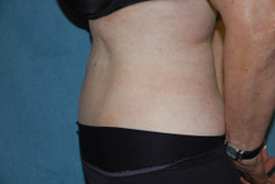 Tummy Tuck Patient 92915 After Photo # 6