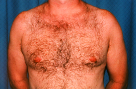 Gynecomastia Patient 45827 After Photo # 4