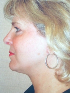 Face Lift and Neck Lift Patient 33637 After Photo # 10