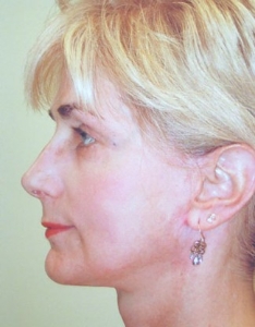 Face Lift and Neck Lift Patient 40143 After Photo # 2