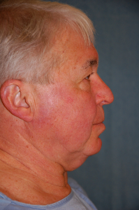 Facial Surgery - Men Patient 91240 Before Photo # 9