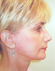 Face Lift and Neck Lift Patient 40143 After Photo # 10