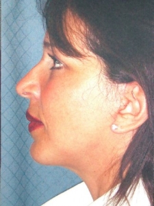 Face Lift and Neck Lift Patient 30136 After Photo # 8