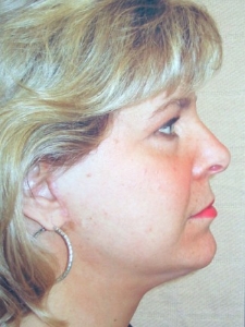 Face Lift and Neck Lift Patient 33637 After Photo # 2