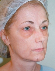 Face Lift and Neck Lift Patient 40143 Before Photo # 7