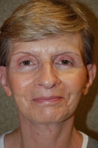Face Lift and Neck Lift Patient 11276 After Photo # 2