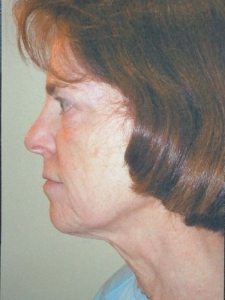 Face Lift and Neck Lift Patient 56718 Before Photo # 1