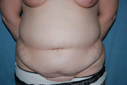 Tummy Tuck Patient 31799 Before Photo # 1