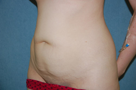 Mini Tummy Tuck Patient 58662 Before Photo # 3