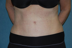 Tummy Tuck Patient 92915 After Photo # 2