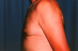 Gynecomastia Patient 45827 After Photo # 6
