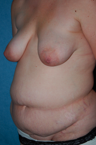Tummy Tuck Patient 36881 Before Photo # 3