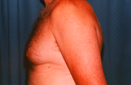 Gynecomastia Patient 45827 Before Photo # 5