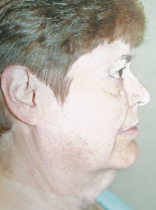 Face Lift and Neck Lift Patient 16711 Before Photo # 1