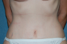 Mini Tummy Tuck Patient 65699 After Photo # 2