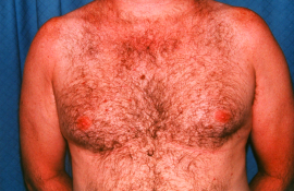 Gynecomastia Patient 45827 Before Photo # 3