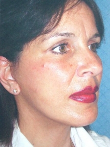 Face Lift and Neck Lift Patient 30136 After Photo # 4