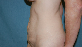 Mini Tummy Tuck Patient 65699 Before Photo # 5