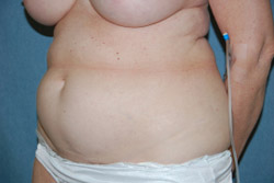 Tummy Tuck Patient 92915 Before Photo # 3