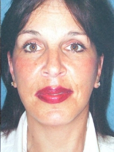 Eye Lift - Blepharoplasty Patient 26561 After Photo # 6