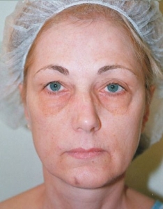 Face Lift and Neck Lift Patient 40143 Before Photo # 5