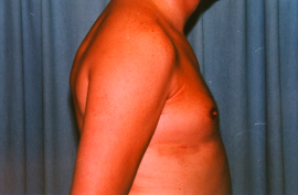 Gynecomastia Patient 93696 After Photo # 6