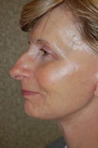 Face Lift and Neck Lift Patient 11276 After Photo # 6