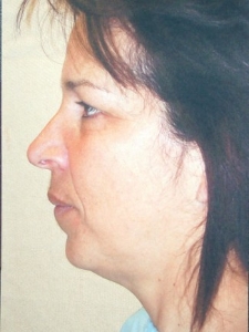 Eye Lift - Blepharoplasty Patient 26561 Before Photo # 7