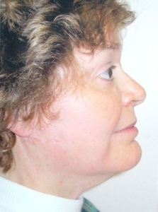 Face Lift and Neck Lift Patient 16711 After Photo # 2