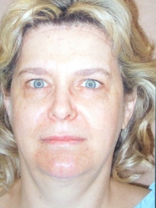 Face Lift and Neck Lift Patient 33637 Before Photo # 5