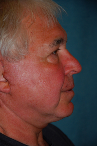 Facial Surgery - Men Patient 91240 After Photo # 10