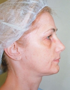 Face Lift and Neck Lift Patient 40143 Before Photo # 9