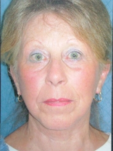 Face Lift and Neck Lift Patient 85131 After Photo # 2