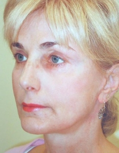 Face Lift and Neck Lift Patient 40143 After Photo # 4