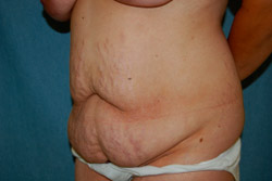 Tummy Tuck Patient 43806 Before Photo # 1