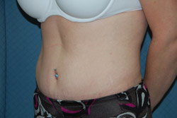 Tummy Tuck Patient 31799 After Photo # 4