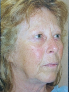 Face Lift and Neck Lift Patient 85131 Before Photo # 3