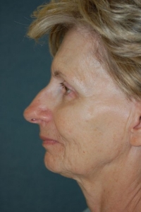 Face Lift and Neck Lift Patient 11276 Before Photo # 5