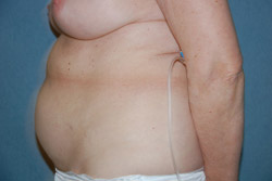 Tummy Tuck Patient 92915 Before Photo # 5